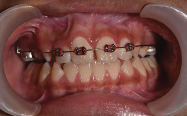 Dental Implants Image 1