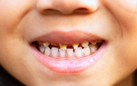 Dental Implants Image 1