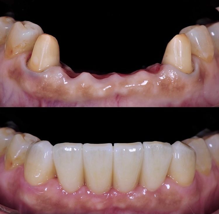 Dental Implants Image 2