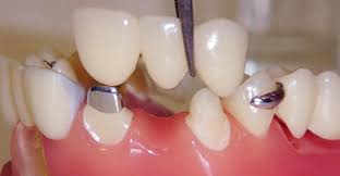 Dental Implants Image 3