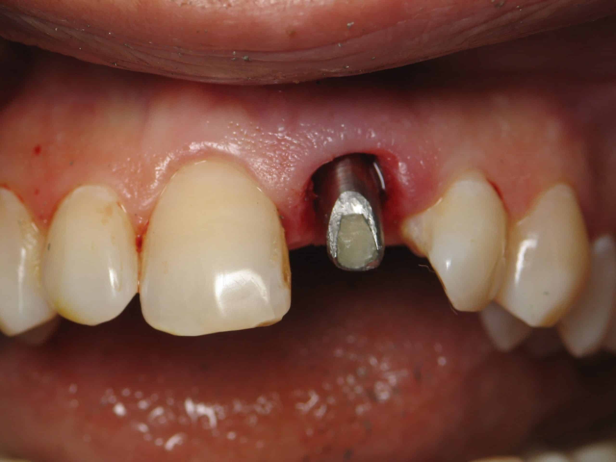Dental Implants Image 1