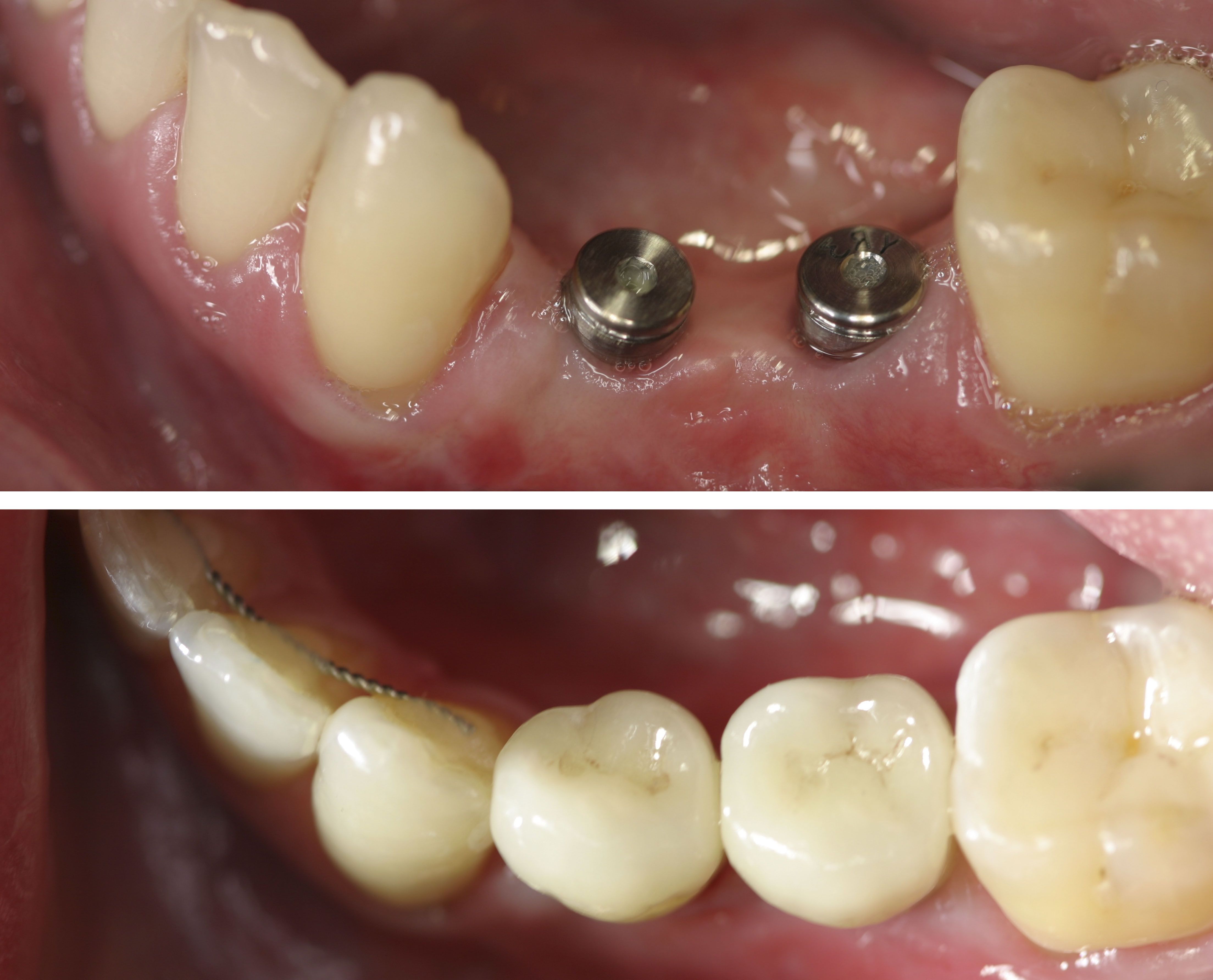 Dental Implants Image 2