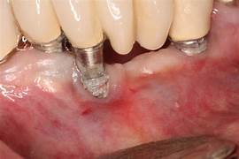 Dental Implants Image 3