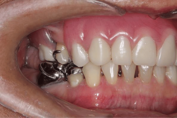 Dental Implants Image 1