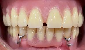 Dental Implants Image 2