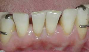 Dental Implants Image 3