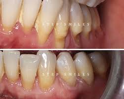 Dental Implants Image 2