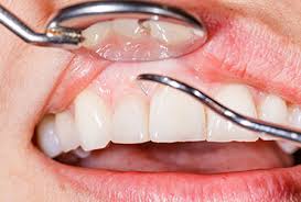 Dental Implants Image 3