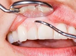 Dental Implants Image 1