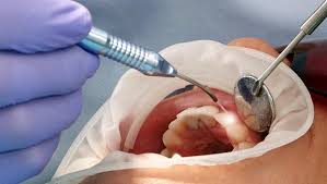 Dental Implants Image 2
