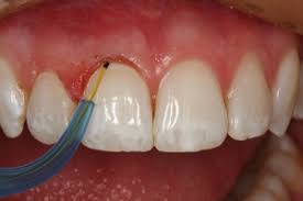 Dental Implants Image 3