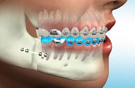 Tooth Scaling Image 1