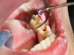 Dental Implants Image 1