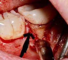 Dental Implants Image 3