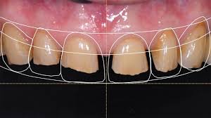Dental Implants Image 1