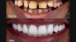 Dental Implants Image 2