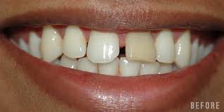 Dental Implants Image 3