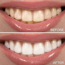 Dental Implants Image 2