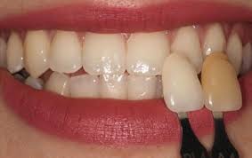 Dental Implants Image 3
