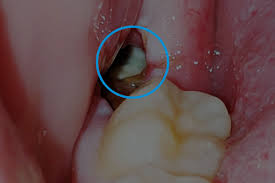 Dental Implants Image 1