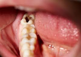 Dental Implants Image 2