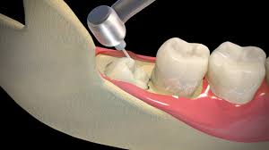 Dental Implants Image 3